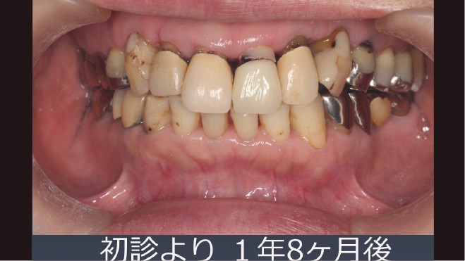 歯周病治療で歯並び改善