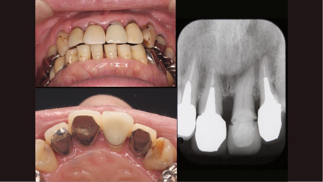 歯周病治療で歯並び改善