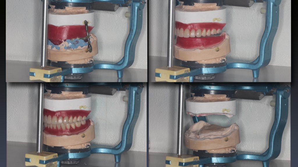 歯科技工　人工歯
